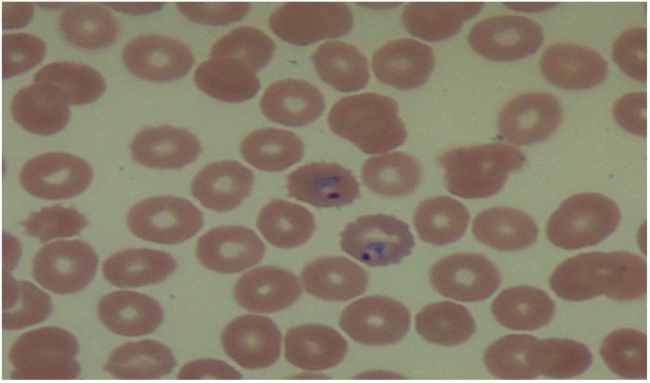 Plasmodium falciparum: ring form in thin blood smear - YouTube