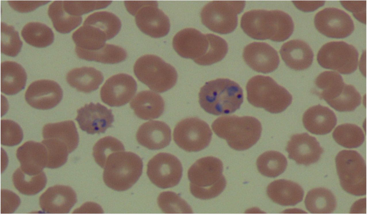 Plasmodium Vivax Inside Red Blood Cells #7 by Kateryna Kon/science Photo  Library