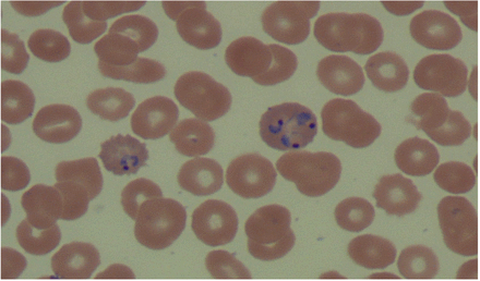 Malaria rapid diagnostic test and Giemsa – stained peripheral blood ...